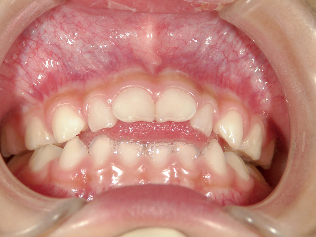 飲み込む時に舌を出す子ども。歯並びやかみ合わせに影響します（日本学校歯科医会提供）